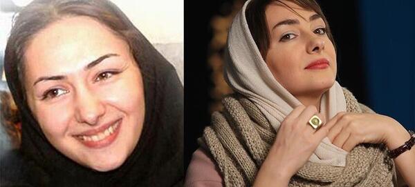 عکس بازیگران زن ایرانی قبل و بعد عمل زیبایی