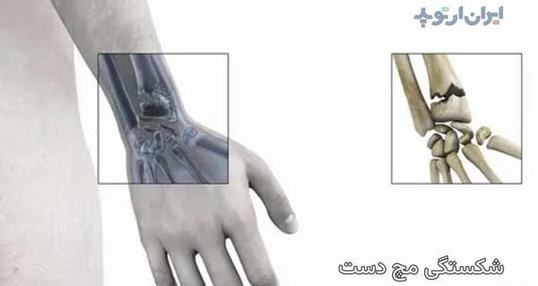 عکس دسته شکسته فیک