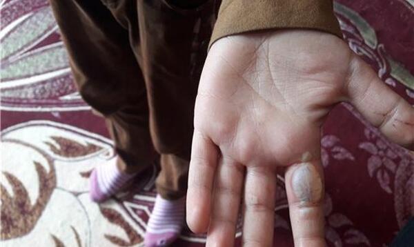 عکس دسته سوخته دختر