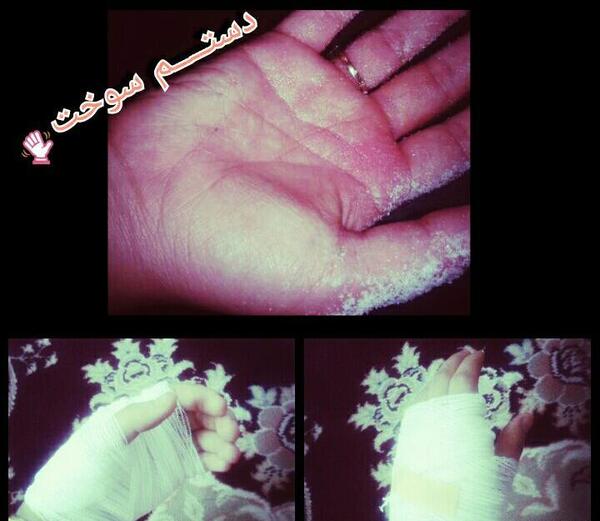 عکس دسته سوخته دختر