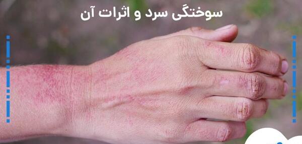 عکس دسته سوخته دختر