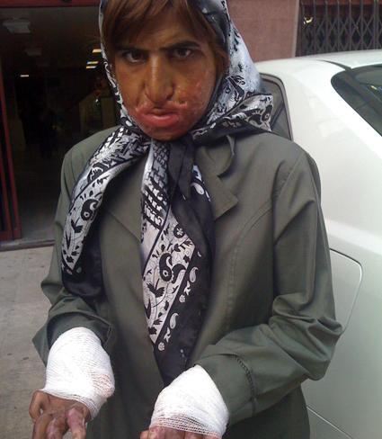 عکس دسته سوخته دختر