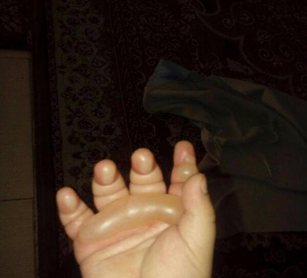 عکس دسته سوخته دختر