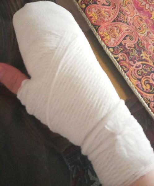 عکس دسته سوخته دختر