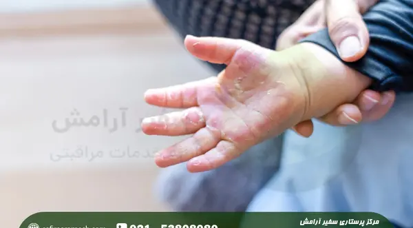 عکس دسته سوخته دختر