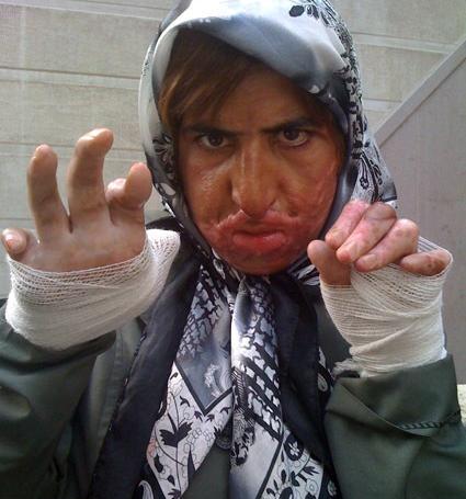 عکس دسته سوخته دختر