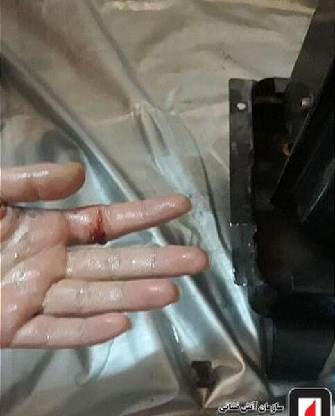 عکس دسته سوخته دختر
