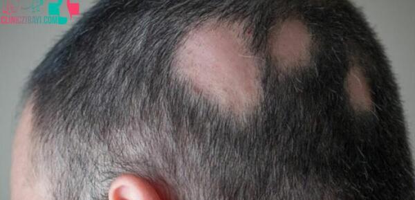 عکس کچلی فرشته حسینی