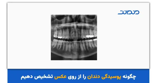 عکس های opg دندان