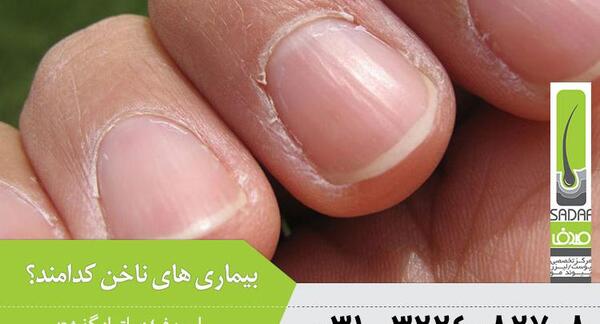 عکس بیماری صدف ناخن