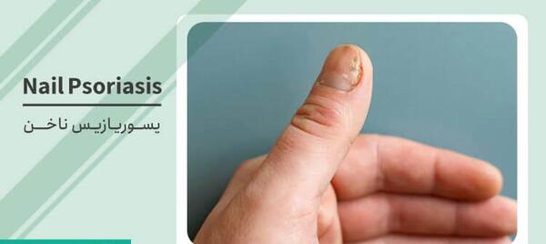 عکس بیماری صدف ناخن