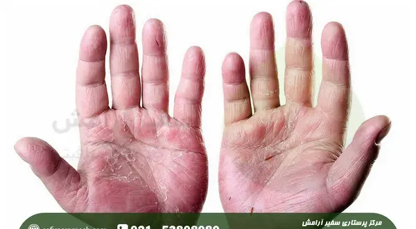عکس بیماری صدف سر