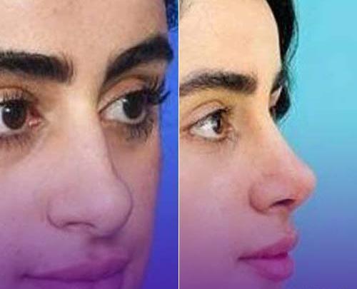 عکس عمل بینی صدف بیوتی