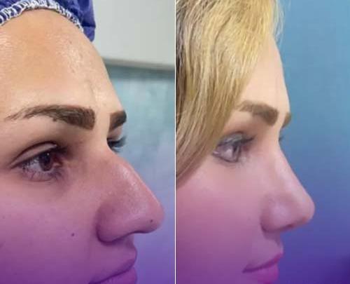 عکس عمل بینی صدف بیوتی