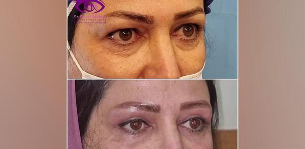 عکس قبل عمل نادیا صالحی