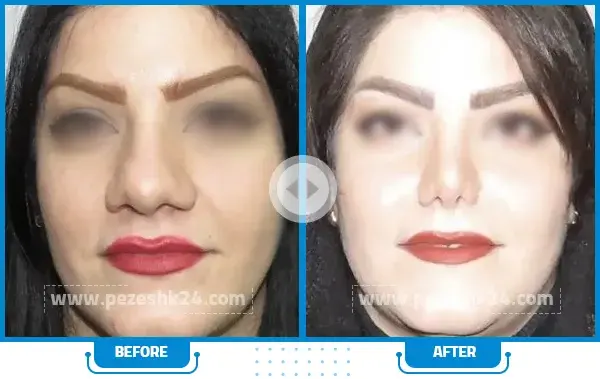عکس عمل بینی دکتر سعید فلاحتی