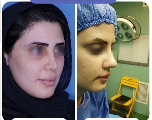عکس عمل بینی دکتر سعید فلاحتی