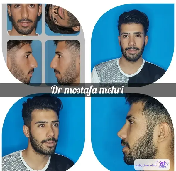 عکس عمل بینی دکتر سعید فلاحتی