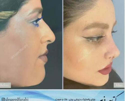 عکس عمل بینی دکتر سعید فلاحتی