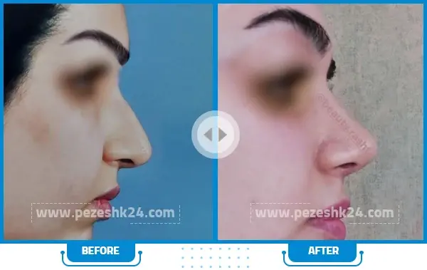 عکس عمل بینی دکتر سعید فلاحتی