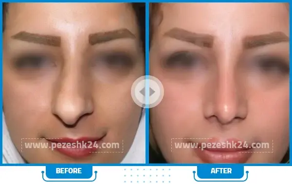 عکس عمل بینی دکتر سعید فلاحتی