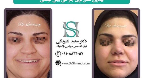 عکس عمل بینی دکتر سعید فلاحتی