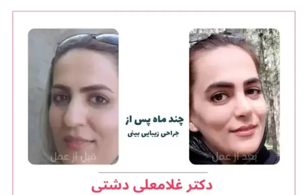 عکس دانیال حکیمی قبل و بعد از عمل بینی