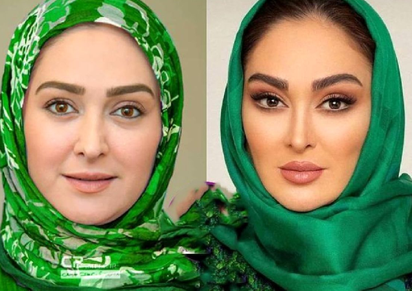 عکس الهام حمیدی قبل و بعد عمل