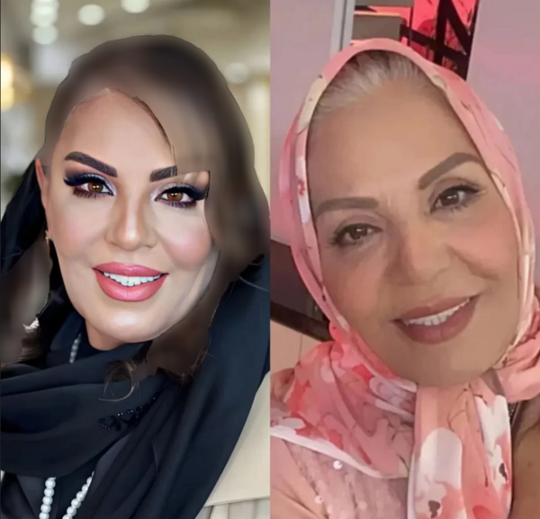 عکس زهره حمیدی بعد از عمل زیبایی
