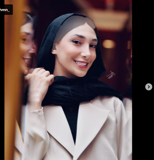 عکس مبینا نعمت زاده قبل عمل