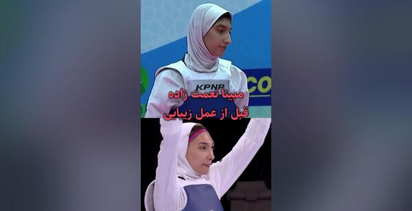 عکس مبینا نعمت زاده قبل عمل