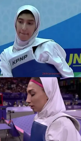 عکس مبینا نعمت زاده قبل عمل