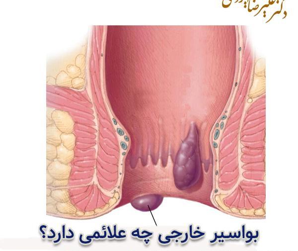 عکس بواسیر در زنان