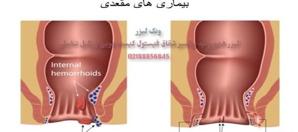 عکس بواسیر در زنان