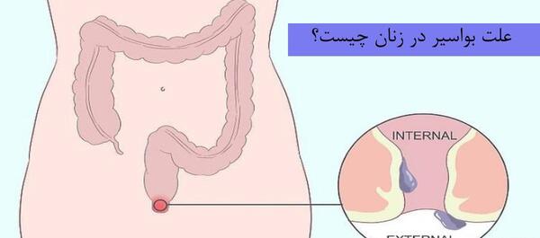 عکس بواسیر در زنان