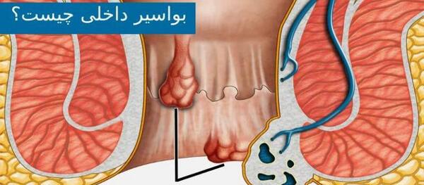 عکس بواسیر در زنان