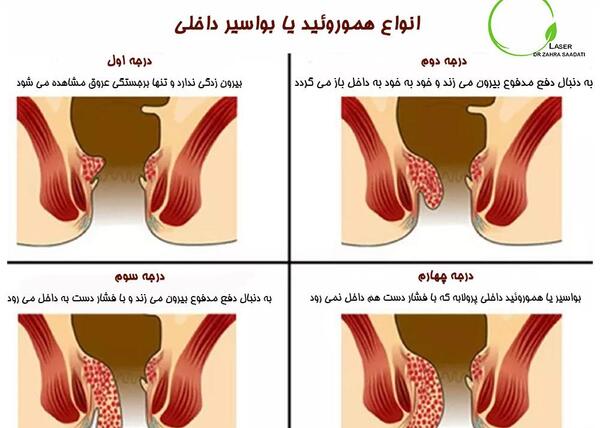 عکس بواسیر در زنان