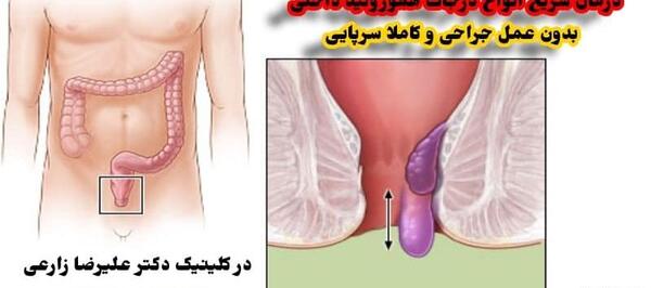 عکس بواسیر در زنان
