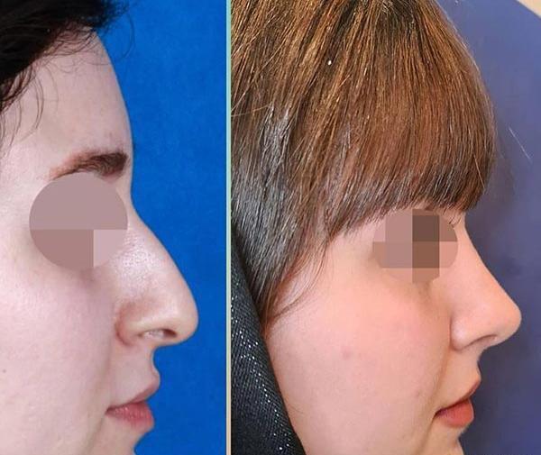 عکس ارزو صادقی قبل از عمل بینی