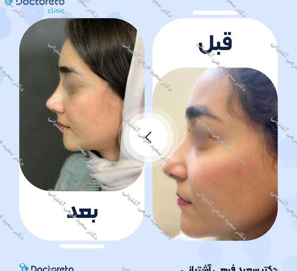 عکس ارزو صادقی قبل از عمل بینی