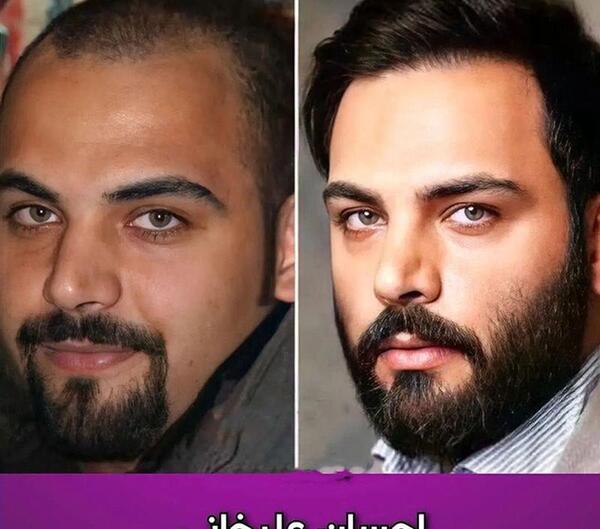 عکس احسان علیخانی قبل از عمل زیبایی