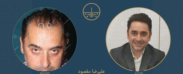 عکس احسان علیخانی قبل از عمل زیبایی