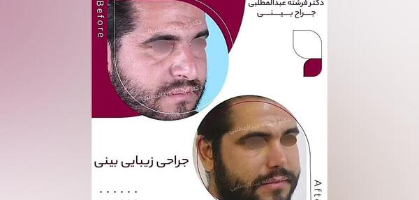 عکس احسان علیخانی قبل عمل بینی