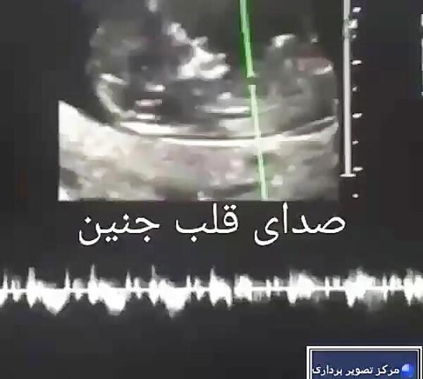 عکس نوشته شنیدن صدای قلب جنین