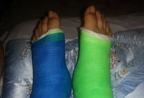 عکس فیک از پای شکسته