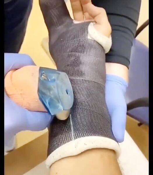 عکس فیک از پای شکسته
