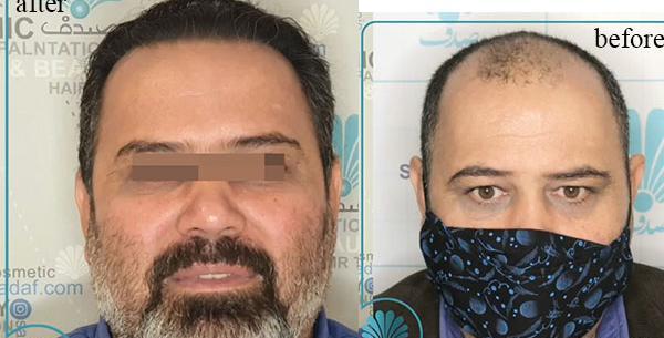 عکس حسین رفیعی قبل از کاشت مو