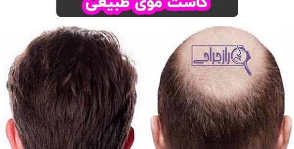 عکس حسین رفیعی قبل از کاشت مو