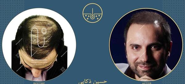 عکس حسین رفیعی قبل از کاشت مو