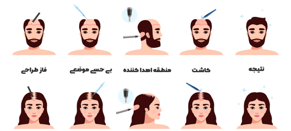 عکس حسین رفیعی قبل از کاشت مو